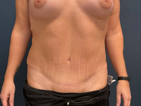 Tummy Tuck case #7178