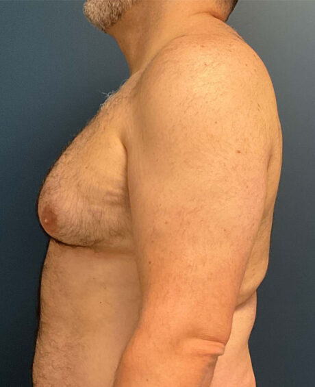 Gynecomastia case #7172