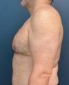 Gynecomastia case #7172