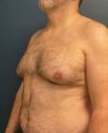 Gynecomastia case #7172