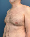 Gynecomastia case #7172