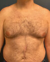 Gynecomastia case #7172