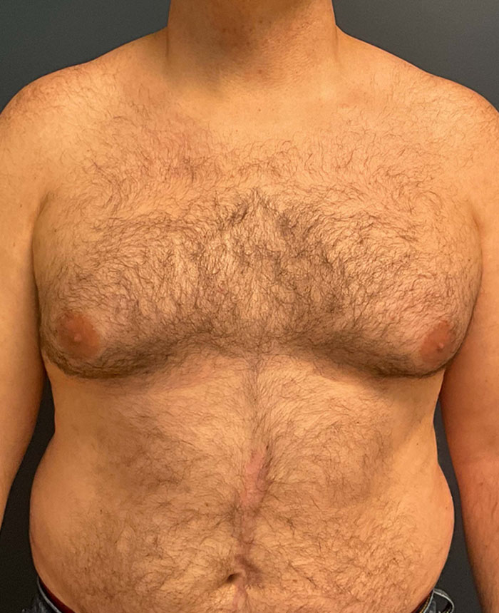 Gynecomastia case #7172