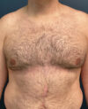 Gynecomastia case #7172