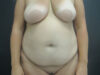 Tummy Tuck case #7439