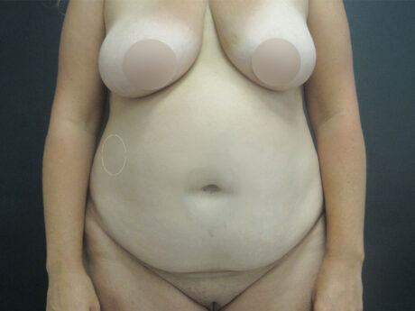 Tummy Tuck case #7439