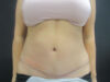 Tummy Tuck case #7439