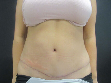 Tummy Tuck case #7439