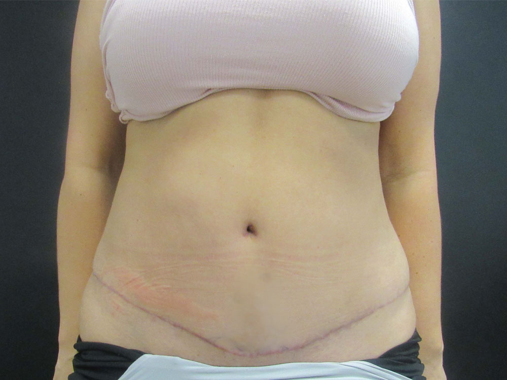 Tummy Tuck case #7439