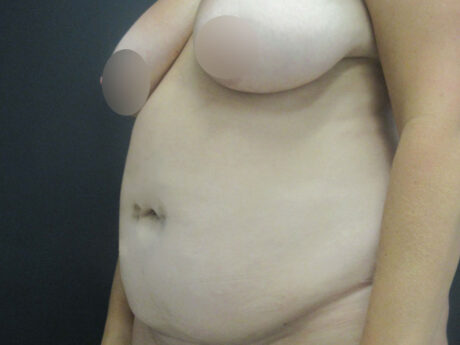 Tummy Tuck case #7439