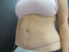 Tummy Tuck case #7439