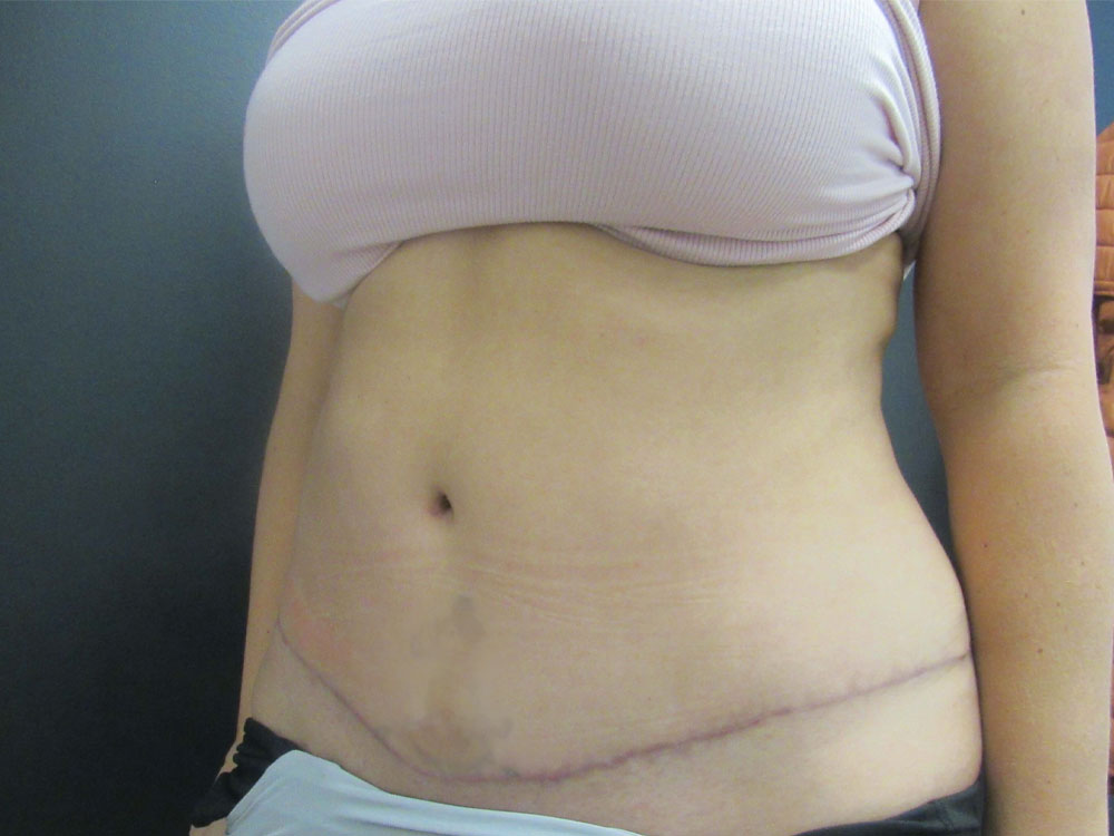 Tummy Tuck case #7439