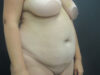 Tummy Tuck case #7439