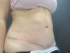 Tummy Tuck case #7439