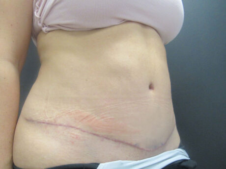 Tummy Tuck case #7439