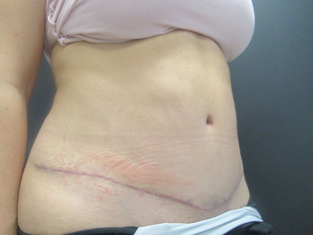 Tummy Tuck case #7439