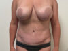 Tummy Tuck case #7498