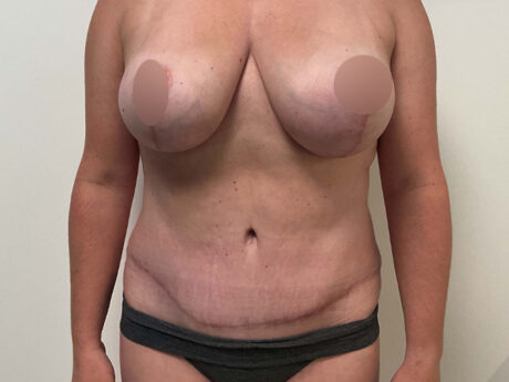 Tummy Tuck case #7498