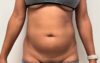 Liposuction case #7988
