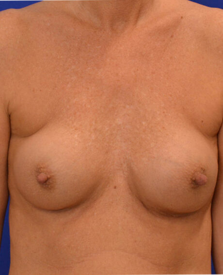 Breast Revision case #7890