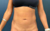 Liposuction case #7988