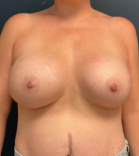 Breast Augmentation case #7884