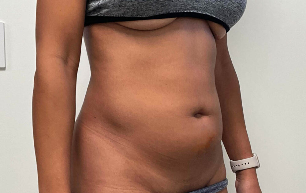 Liposuction case #7988