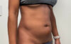 Liposuction case #7988