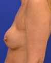 Breast Revision case #7890