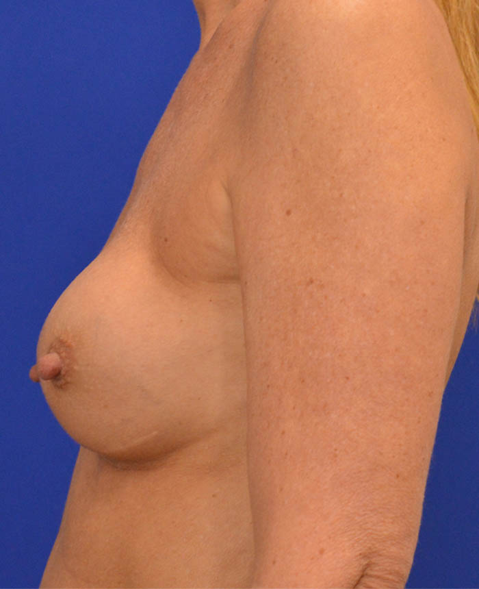 Breast Revision case #7890