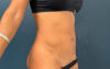 Liposuction case #7988
