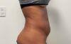 Liposuction case #7988