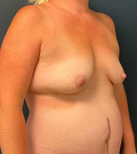 Breast Augmentation case #7884