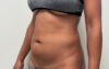 Liposuction case #7988