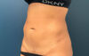 Liposuction case #7988