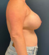 Breast Augmentation case #7884