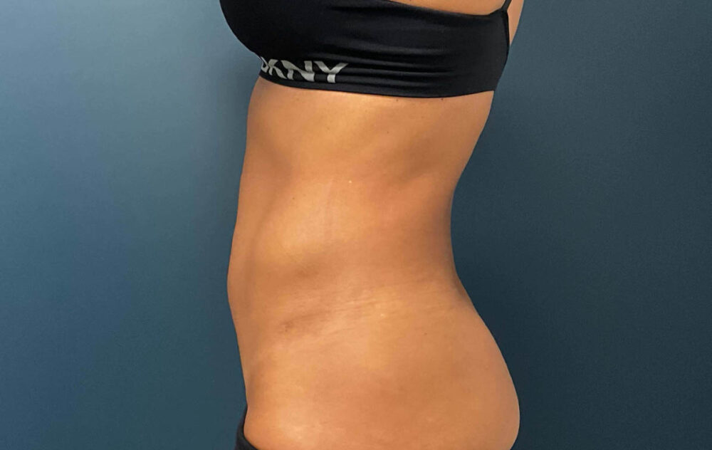 Liposuction case #7988