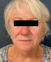 Facelift case #7785