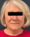 Facelift case #7785