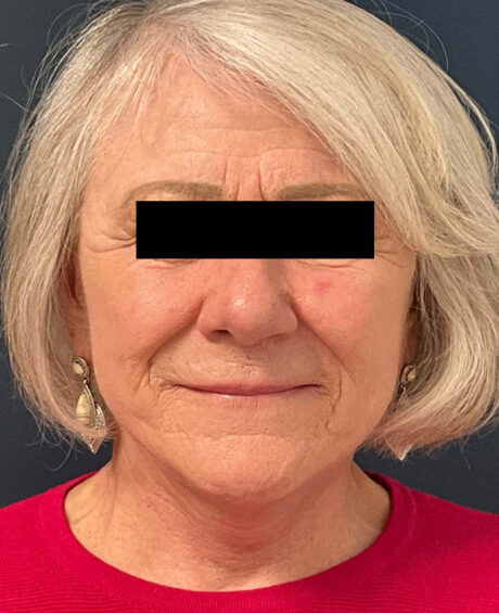 Facelift case #7785