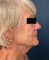 Facelift case #7785