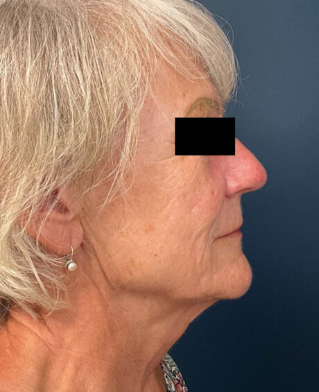 Facelift case #7785