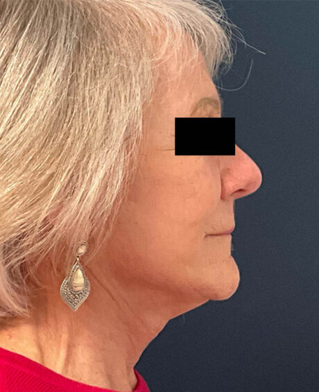 Facelift case #7785