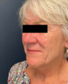 Facelift case #7785