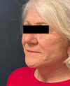 Facelift case #7785