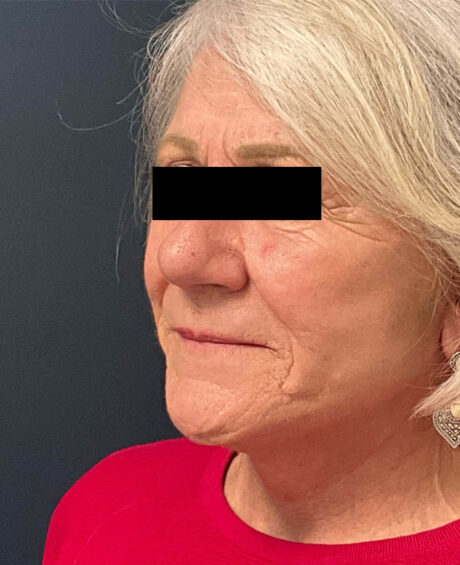 Facelift case #7785