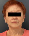 Facelift case #7712