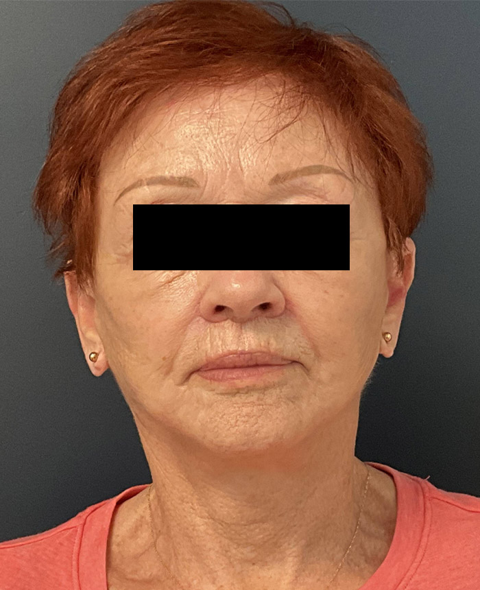 Facelift case #7712
