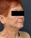 Facelift case #7712
