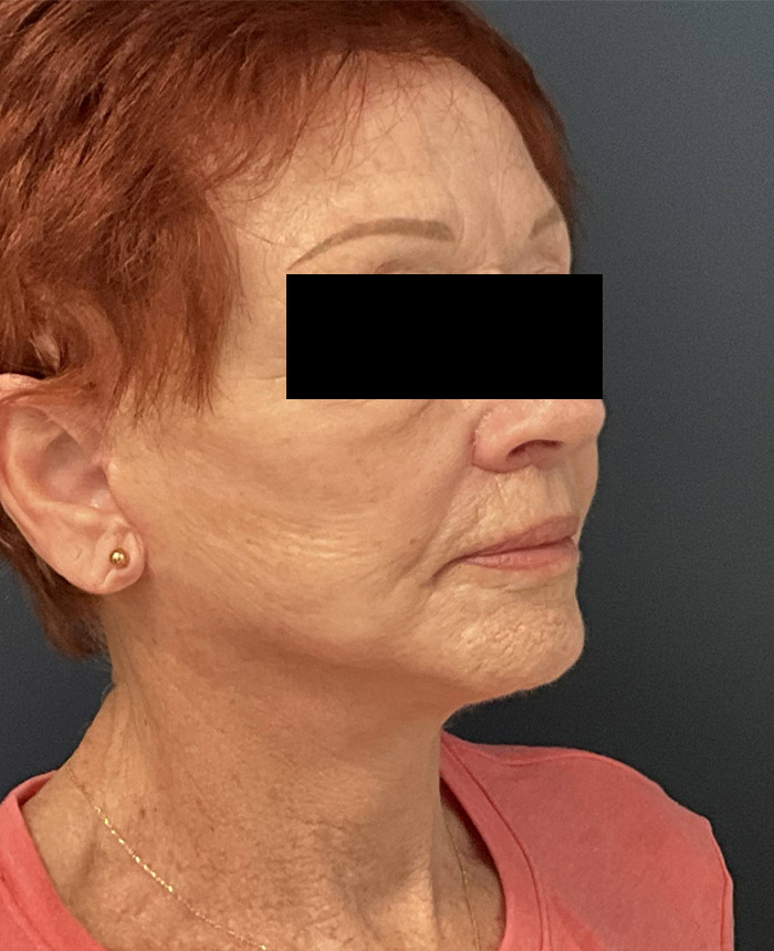 Facelift case #7712